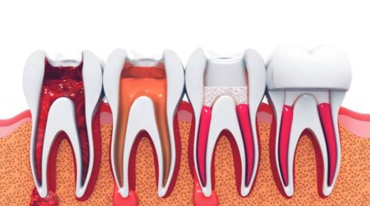 Root canal therapy 101 – An overview before visiting a dentist in Southfield