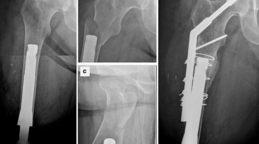 DEXA scan colorado