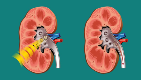 Kidney Stone Treatment