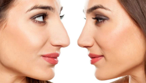 Rhinoplasty in Bangalore