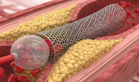 Coronary Angioplasty Treatment In Hyderabad